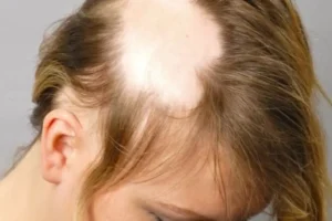 Alopecija kod djece savjeti