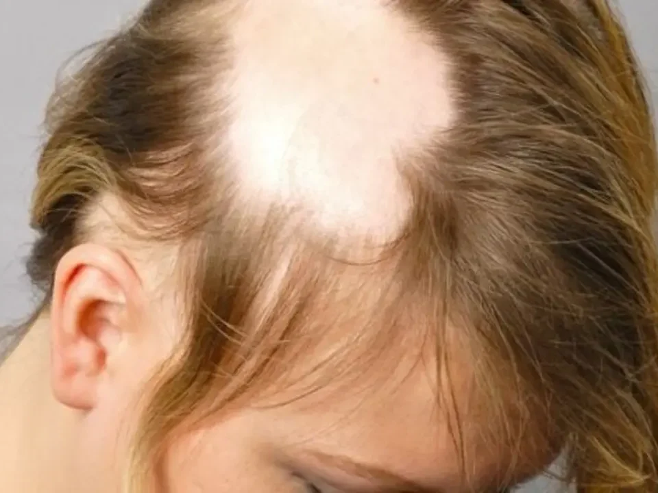 Alopecija kod djece savjeti